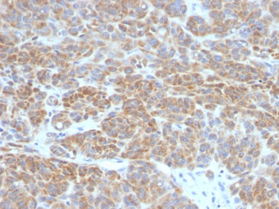 FFPE human melanoma sections stained with 100 ul anti-Bcl-2 (clone BCL2/782) at 1:100. HIER epitope retrieval prior to staining was performed in 10mM Tris 1mM EDTA, pH 9.0.